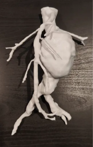 Aortic Aneurysm