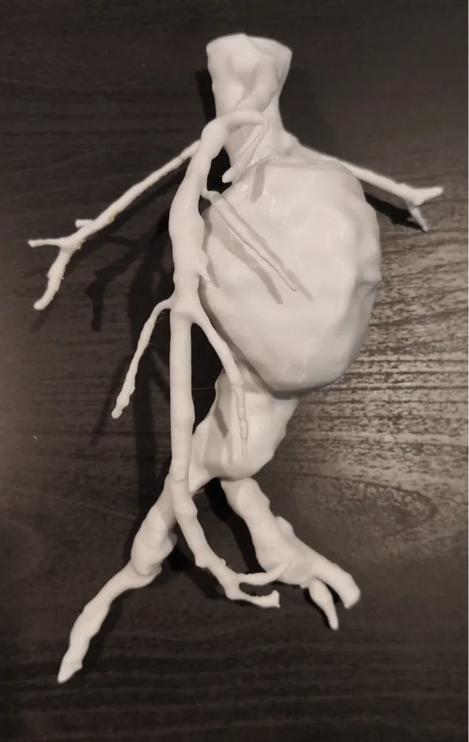 Aortic Aneurysm