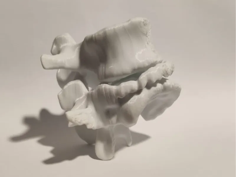 Vertebra Trauma
