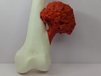 OESTEOCONDROMA