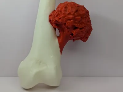 OESTEOCONDROMA