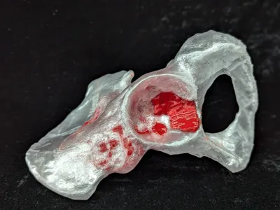 Hemi-pelvis