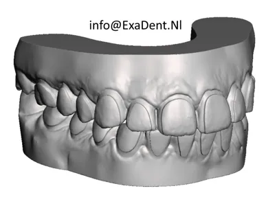 Dental Bleaching Upper Jaw Model 