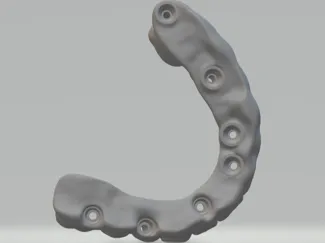 dental bridge on implant