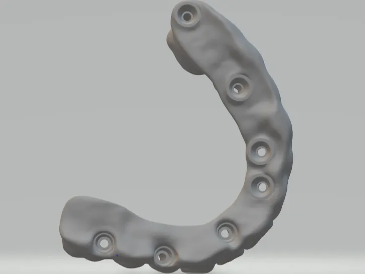 dental bridge on implant 