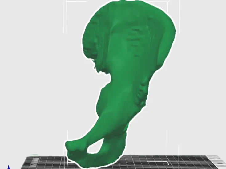 Anatomical Model of Protrusio Acetabuli