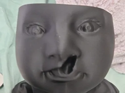 lip Cleft no image