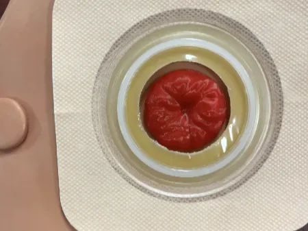 Stoma