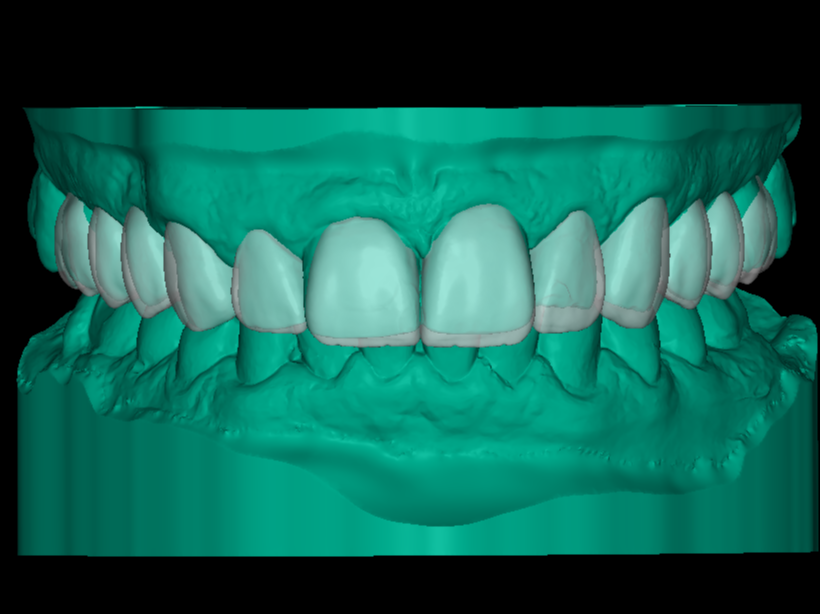 Full Dental Arch – Upper & Lower Digital Model STL