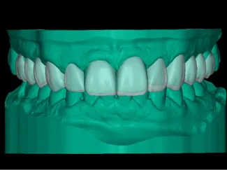 Full Dental Arch – Upper & Lower Digital Model STL