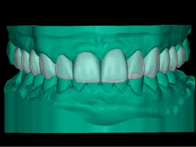 Full Dental Arch – Upper & Lower Digital Model STL