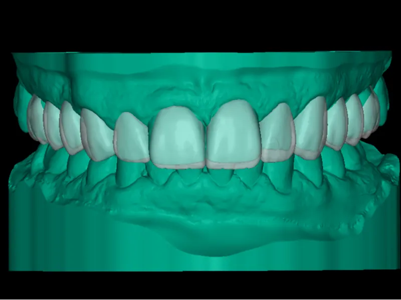 Full Dental Arch – Upper & Lower Digital Model STL