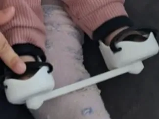 doll foot abduction brace (FAB)