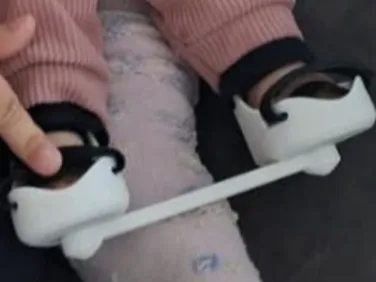 doll foot abduction brace (FAB)