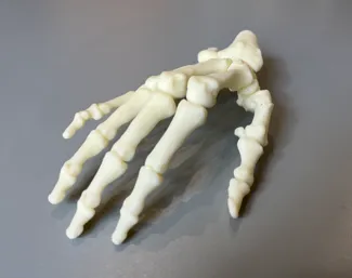 手部掌骨骨折案例
