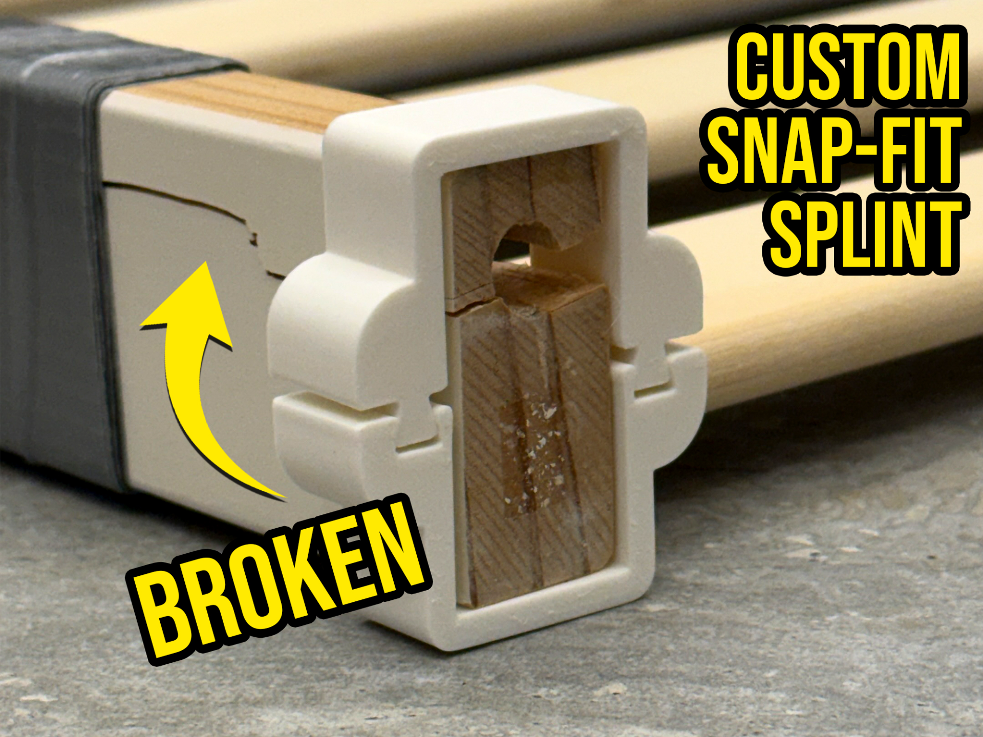 Custom Snap-Fit Splint (Dovetail Repair Bracket)