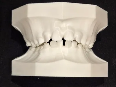 Mixed Dentition Typodont - Class II, Div 1