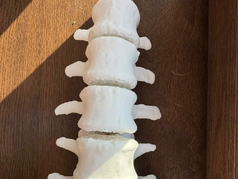 Lumbar Spine - Real Patient 3D Model