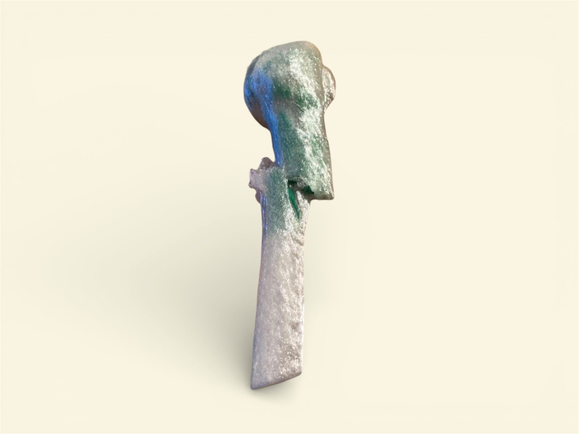 Fractured Humerus with Tumor (from CT SCAN)