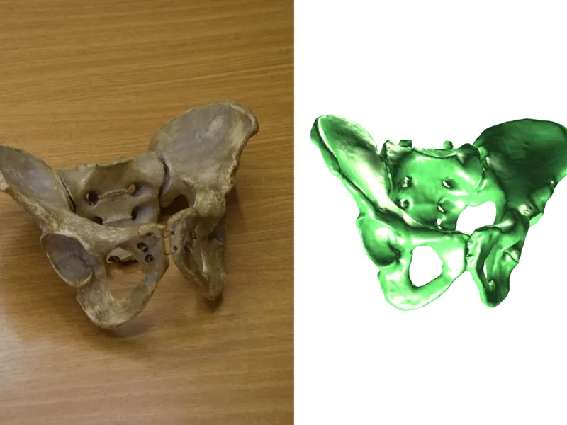 Pelvis Scan - Pelvis