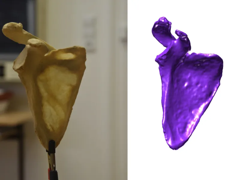 Shoulder Blade Scan - Scapula (R)