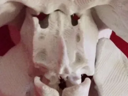 ethmoid with supports