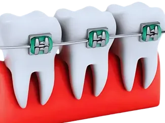 MODELO DE DIENTES CON ORTODONCIA