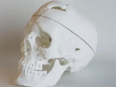 Phineas Gage Skull