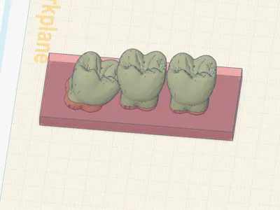 Partial Impaction of lower molar