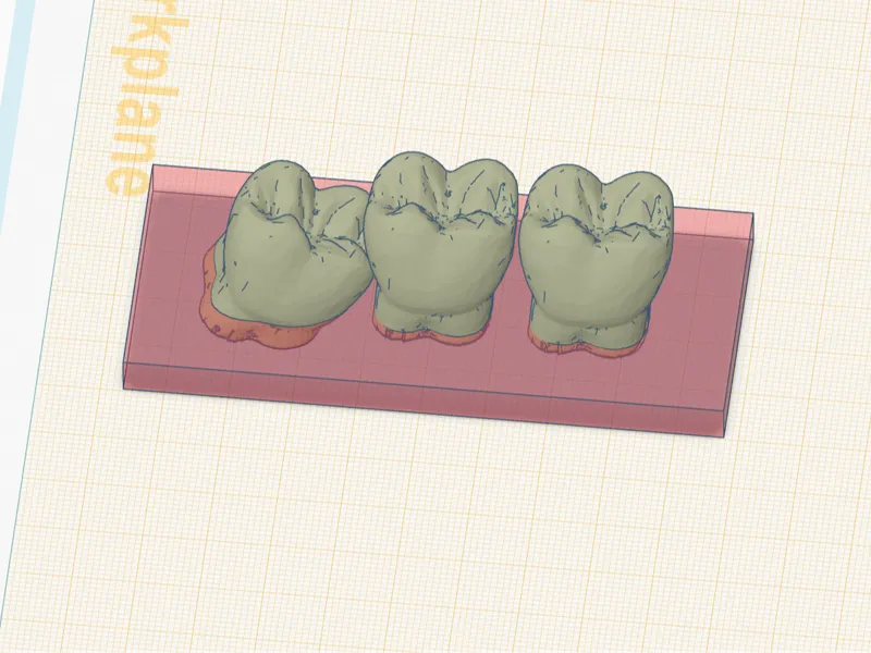 Partial Impaction of lower molar