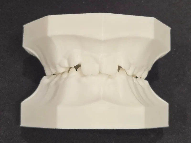 Mixed Dentition Typodont - Class II, Div 2