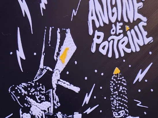 Angine de Poitrine
