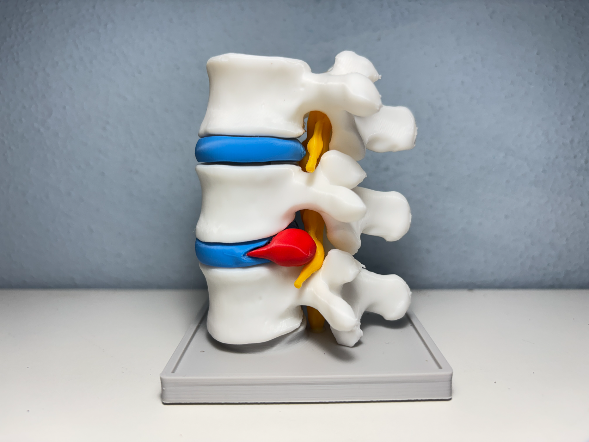 (NO AMS) Herniated Disc - Lumbar Spine - 1