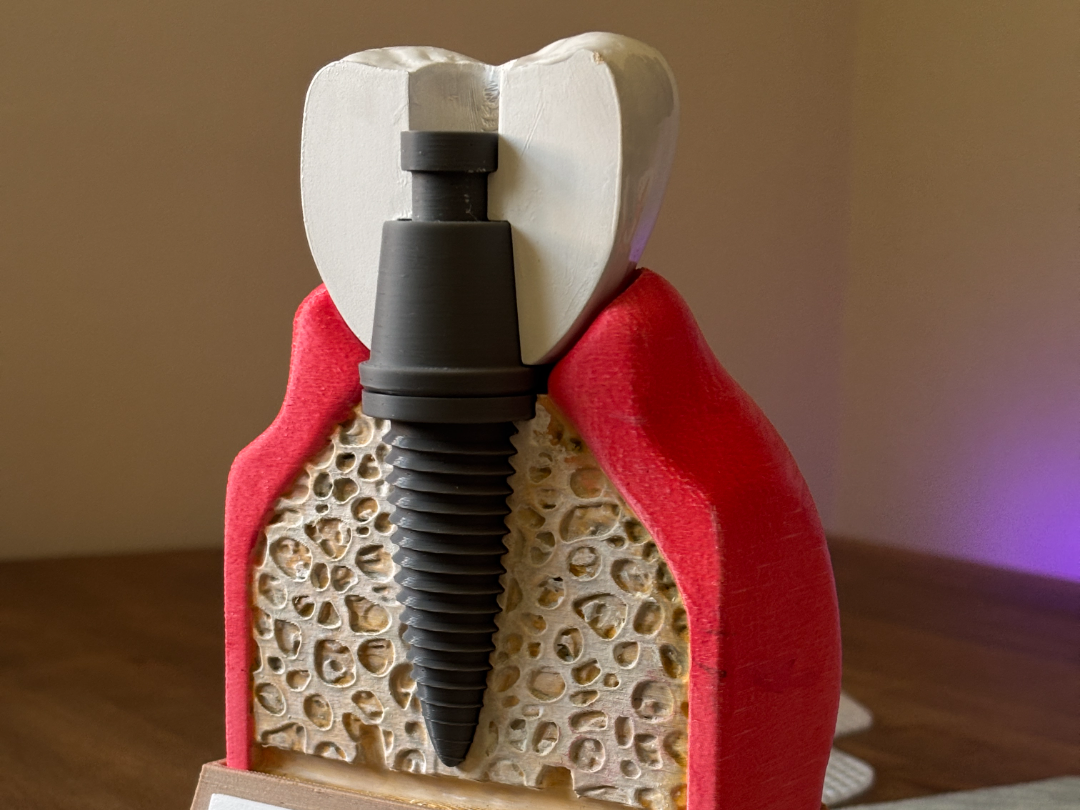 Dental Implant & Gum Demonstration Model - 1