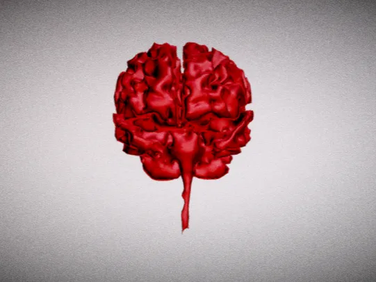 Brain with Alzheimer's