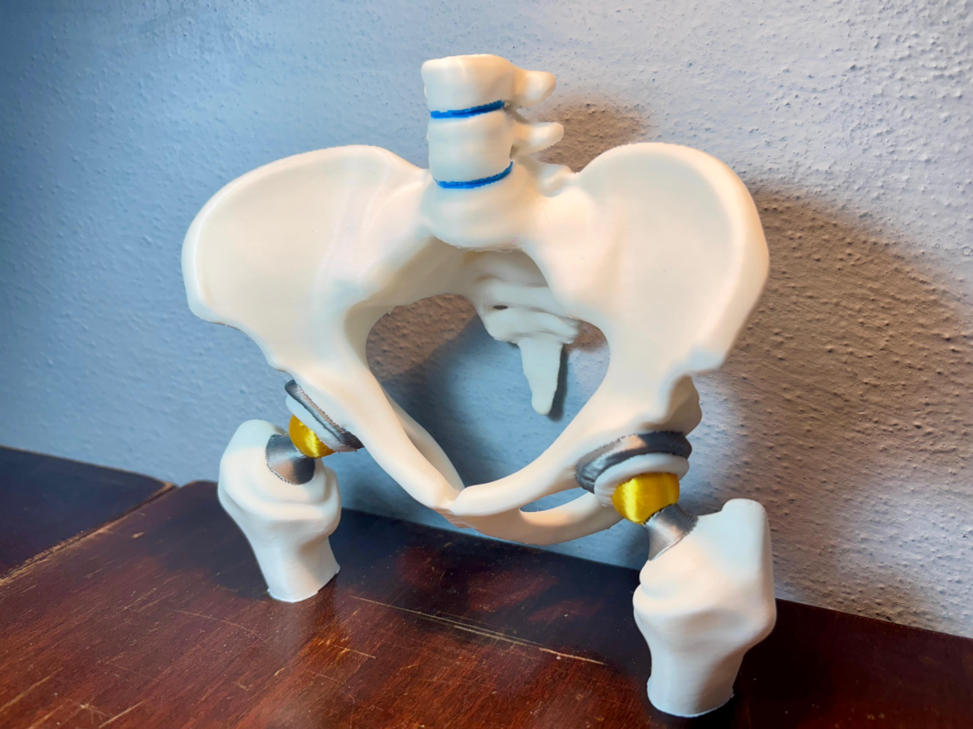 Bilateral Hip Prosthesis