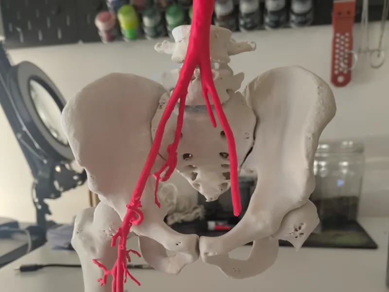 Aorta, Iliac and femoral arteries