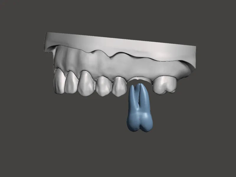 Modello dentale con dente sfilabile