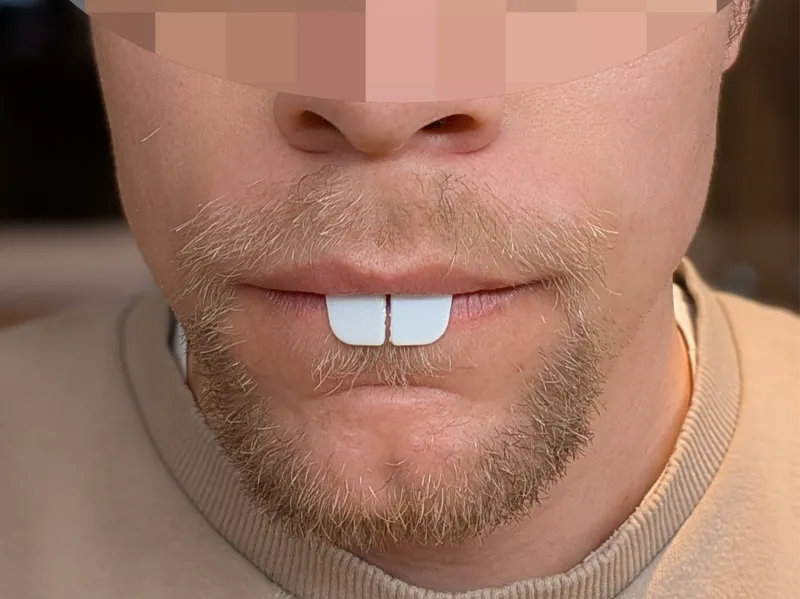 Rabbit teeth