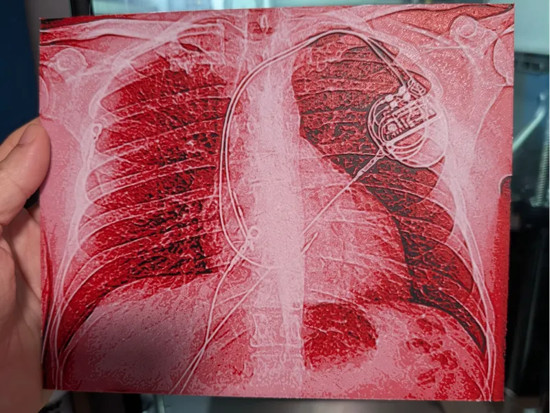 Pacemaker Cardiologist Valentine Chroma X-Ray