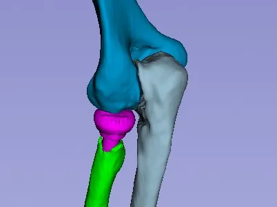 Protesis de cupula radial